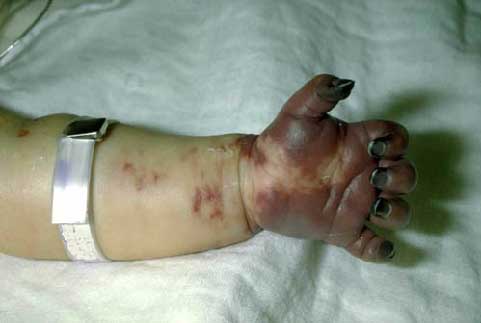 Sepsis with gangrene of hand, Haemophilus influenzae type b